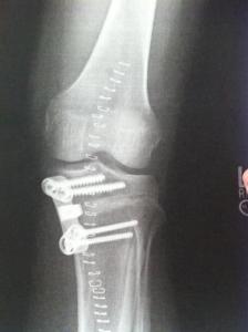 One week postop xray. Dead guy bone.